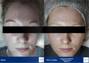 Obagi Medical before and after