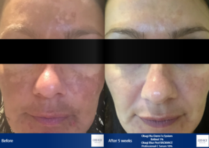 Obagi Medical before and after